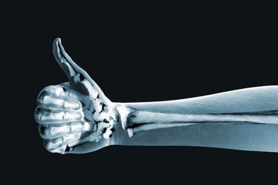 उंगलियों के जोड़ों में दर्द का निदान करने के लिए एक्स-रे