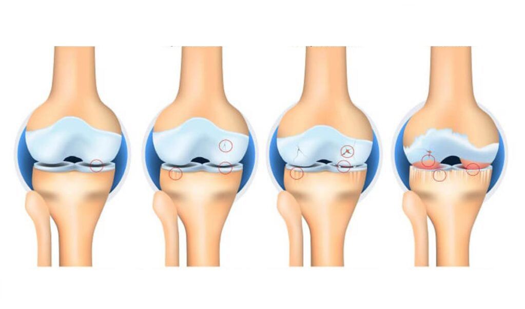 घुटने के जोड़ के आर्थ्रोसिस के चरण