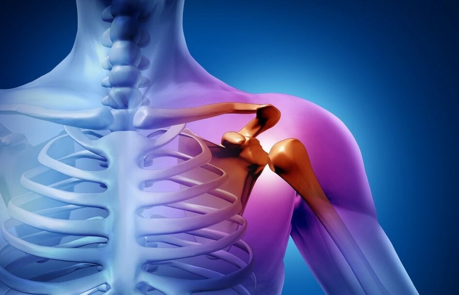 आर्थ्रोसिस के कारण कंधे के जोड़ में चोट
