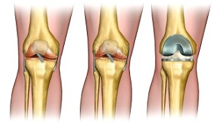 घुटने के जोड़ के आर्थ्रोसिस के लिए एंडोप्रोस्थेटिक्स